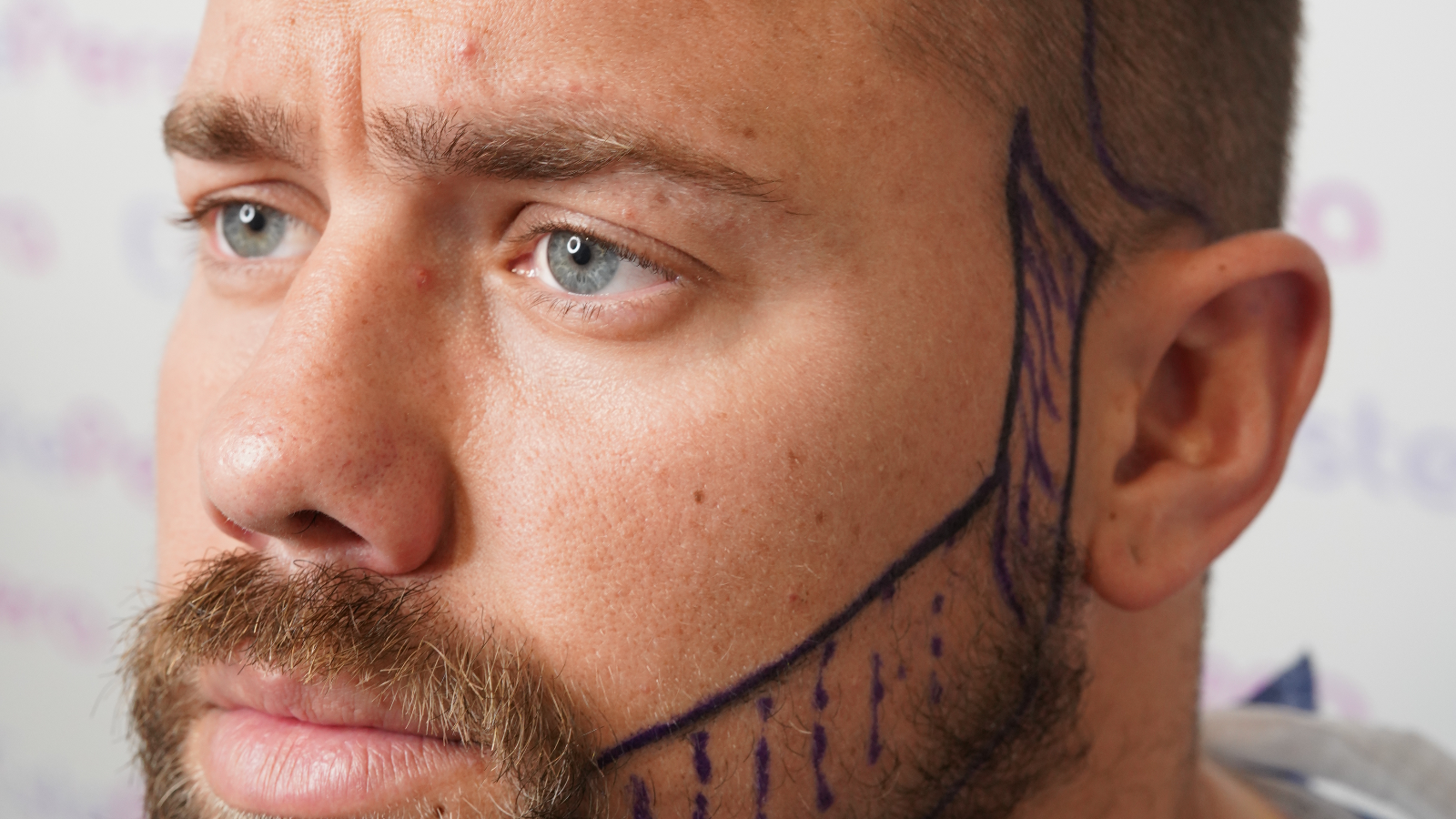 Los Trasplante de Barba son otra de nuestros servicios.