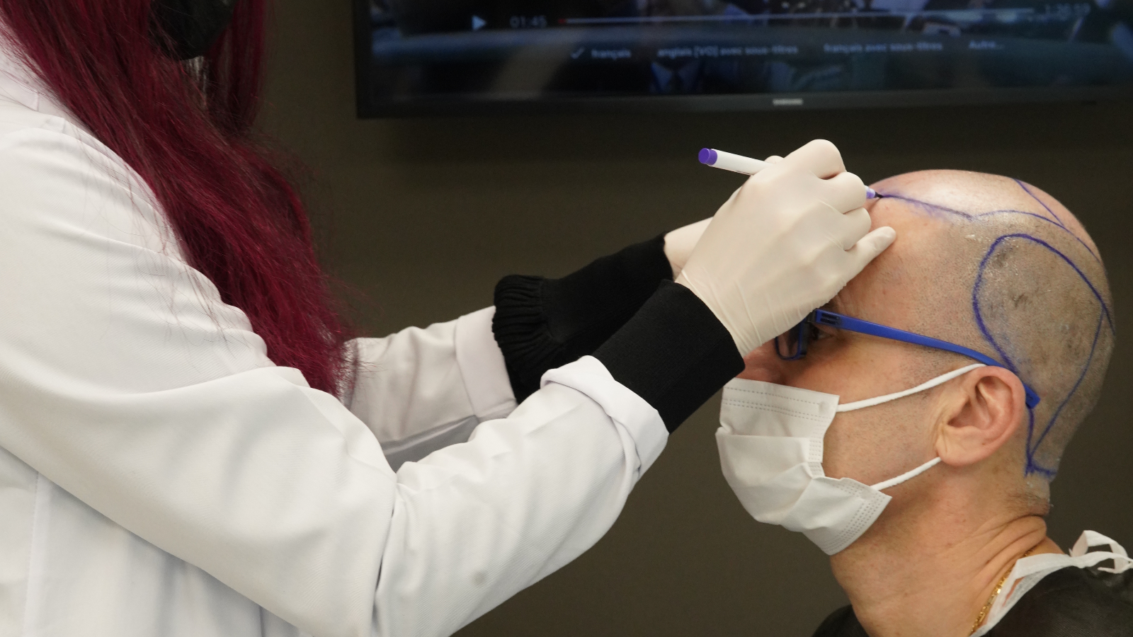 Mas de 15 años de experiencia en Trasplante Capilar, centro de referencia en ESTAMBUL.